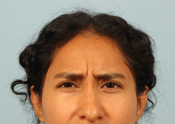 Neurotoxin Before and After 02