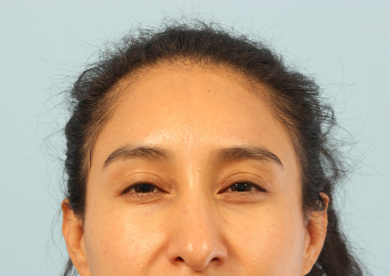 Neurotoxin Before and After 02