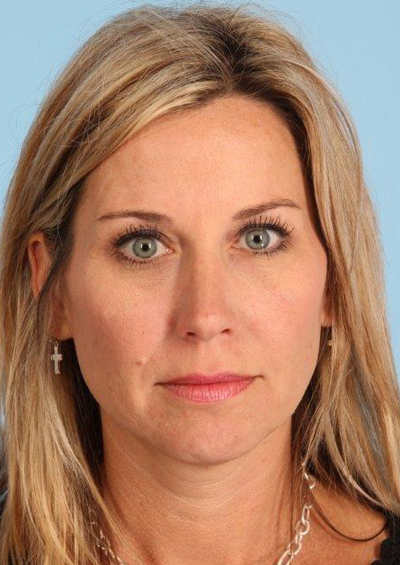 Neurotoxin Before and After 01