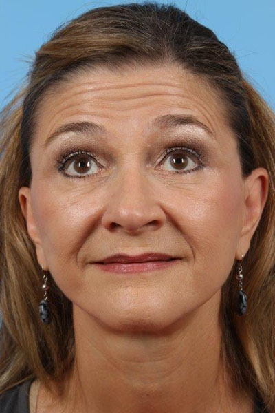 Neurotoxin Before and After 04