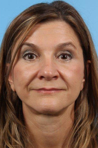 Neurotoxin Before and After 04