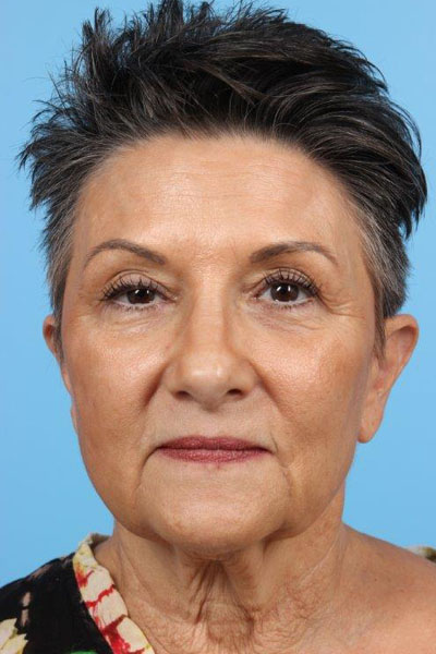 Neurotoxin Before and After 05