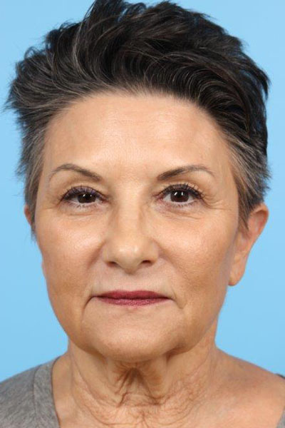 Neurotoxin Before and After 01