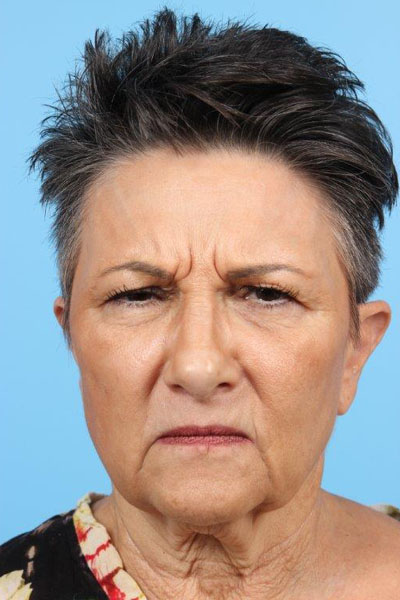 Neurotoxin Before and After 05