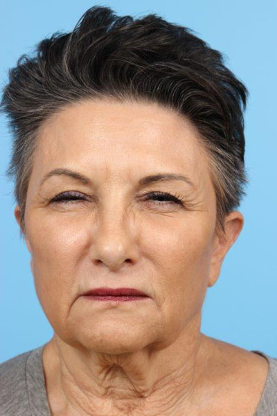 Neurotoxin Before and After 05