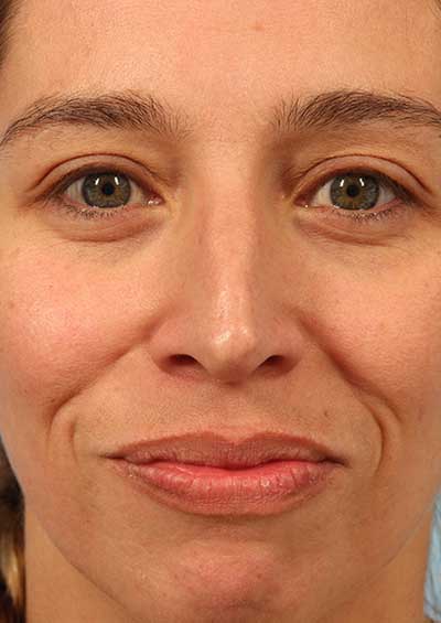 Neurotoxin Before and After 08