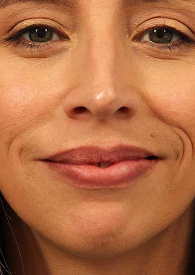 Neurotoxin Before and After 01