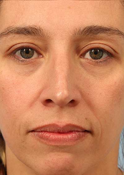 Neurotoxin Before and After 08