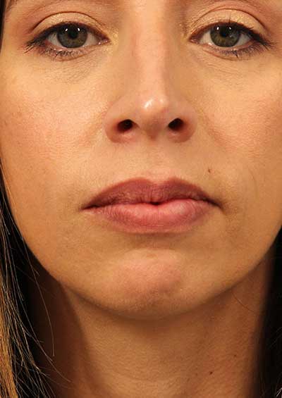 Neurotoxin Before and After 08