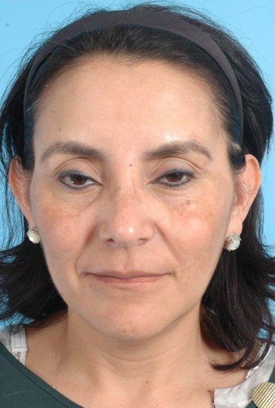 Photofacial Ipl Before and After 01