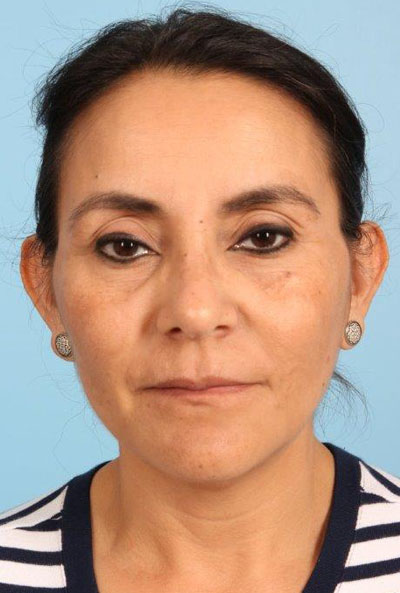 Photofacial Ipl Before and After 01