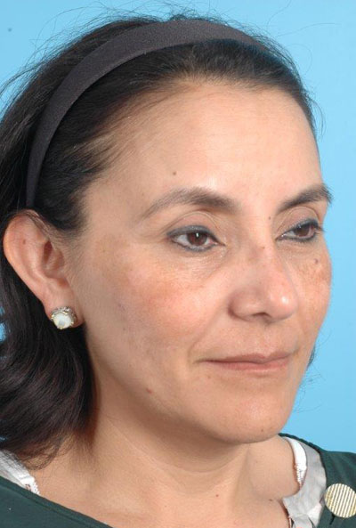 Photofacial Ipl Before and After 01