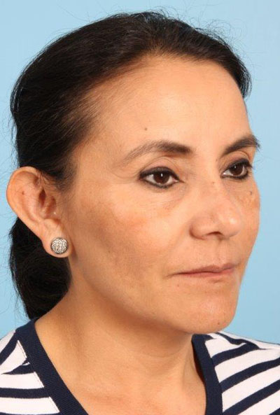 Photofacial Ipl Before and After 01