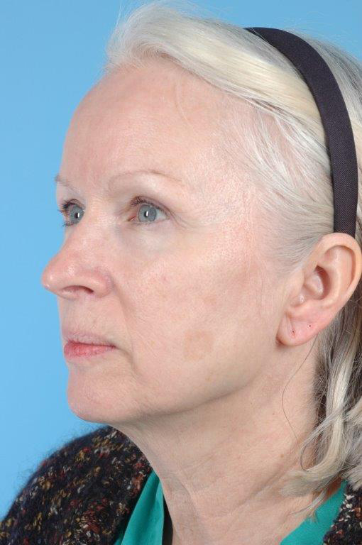 Skin Resurfacing Before and After 04