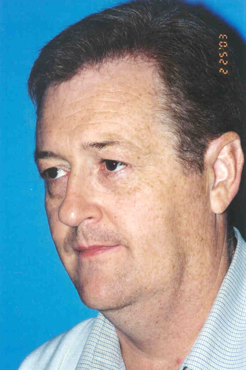 Facelift Before and After 05