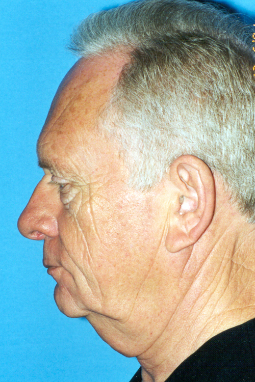 Facelift Before and After 06