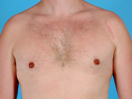 Gynecomastia Before and After 08