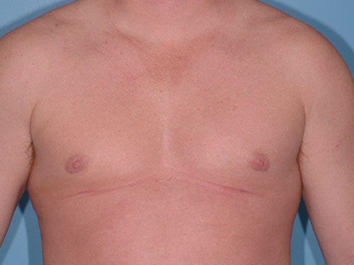 Gynecomastia Before and After 06