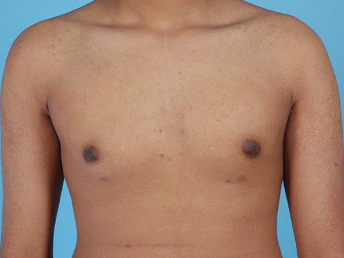 Gynecomastia Before and After 09