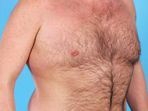Gynecomastia Before and After 05