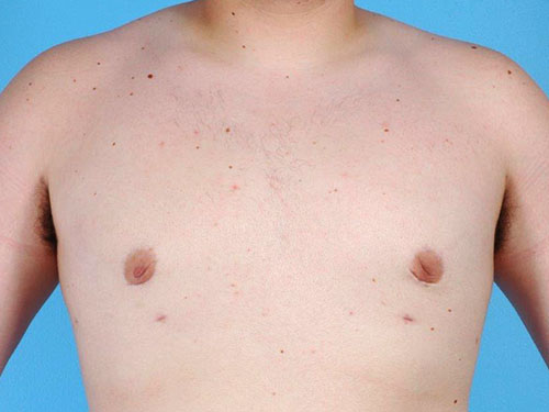 Gynecomastia Before and After 04
