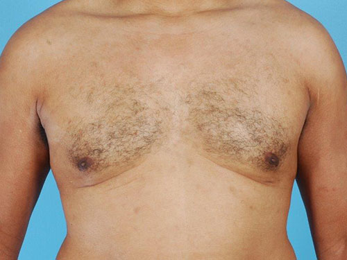 Gynecomastia Before and After 10