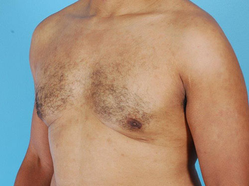 Gynecomastia Before and After 07