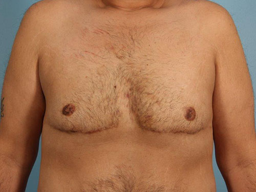 Gynecomastia Before and After 08