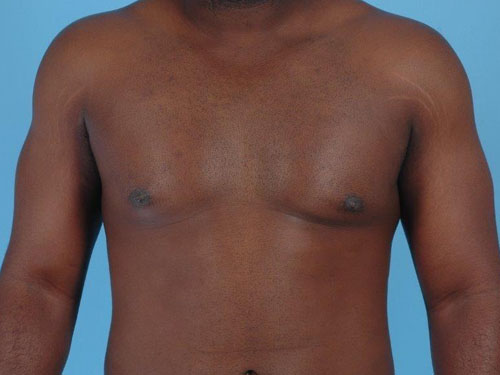 Gynecomastia Before and After 10