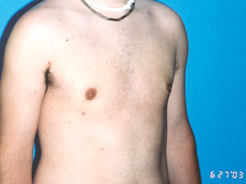 Gynecomastia Before and After 05