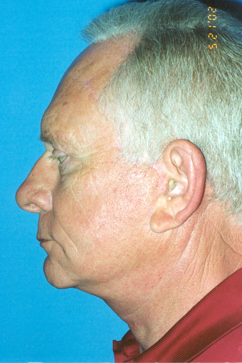 Neck Lift Before and After 01