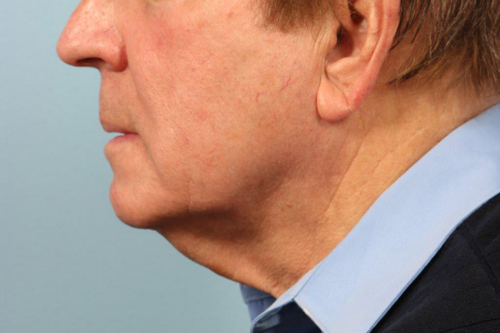 Neck Liposuction Before and After 02
