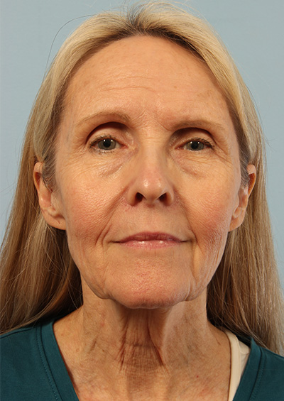 Dermabrasion Before and After 01