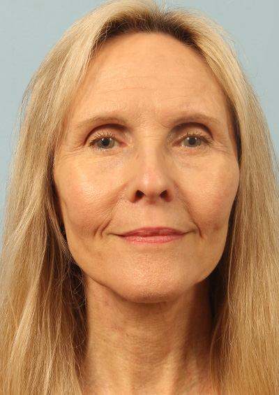 Dermabrasion Before and After 01