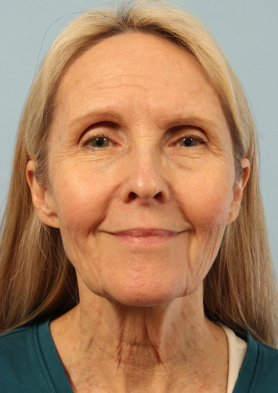 Dermabrasion Before and After 01