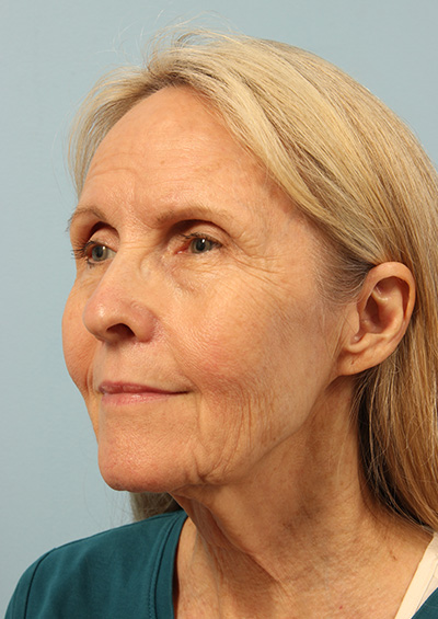 Dermabrasion Before and After 01