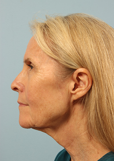 Dermabrasion Before and After 01