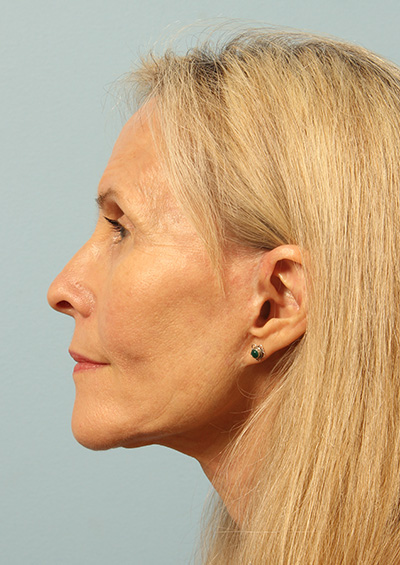 Dermabrasion Before and After 01