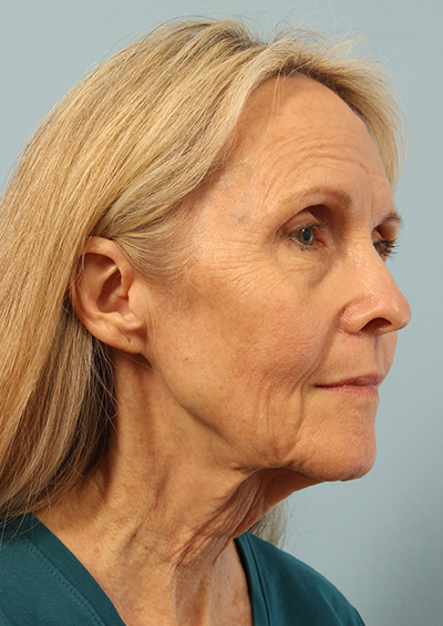 Dermabrasion Before and After 01