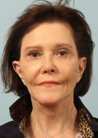 Dermabrasion Before and After 01