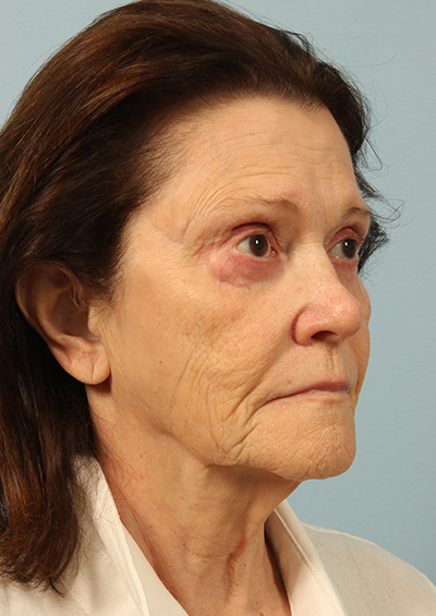 Dermabrasion Before and After 02