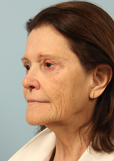 Dermabrasion Before and After 02