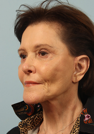 Dermabrasion Before and After 02