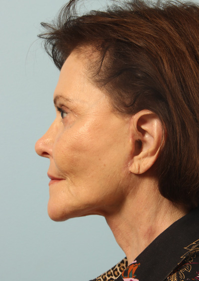 Dermabrasion Before and After 02