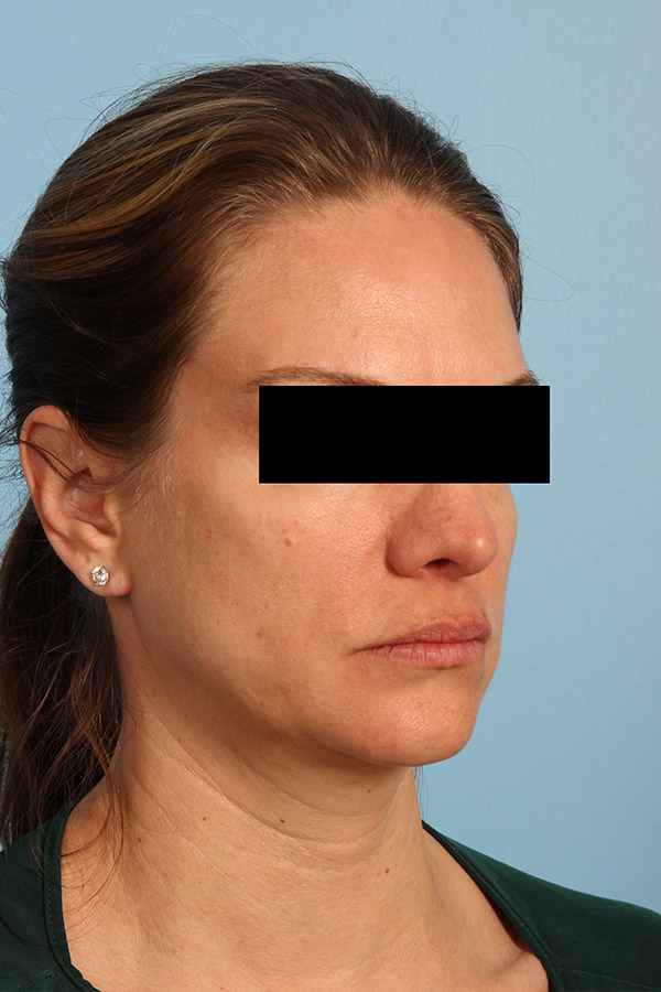 Ultherapy Before and After 04